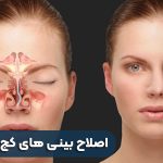 راه های درمان بینی های کج و نامتقارن